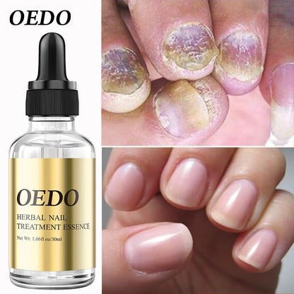 OEDO Herbal Nourishing Nail Care liquid Whitening nails Remove infection Improve rough nails Restore nail shine Nail Polish
