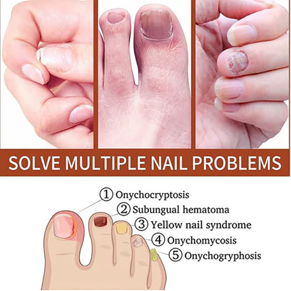 Nail Fungus Treatments Serum Anti-Infection 7DAYS Repair Foot Onychomycosis Paronychia Toe Care Nails Fungal Removal Gel  uñas