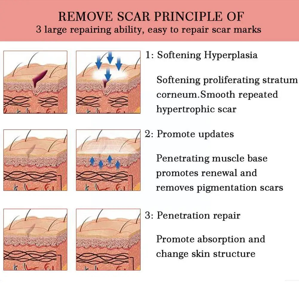 Yoxier Lavender Scar Repair Cream Acne Scar Removal Whitening Smooth Marks Skin Pigmentation Corrector Scar Removal Gel